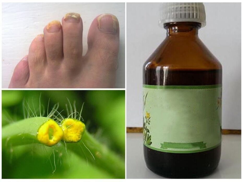 jus de chélidoine contre les mycoses des ongles