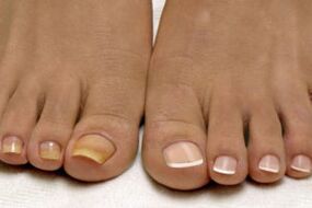 pieds avant et après le traitement de la mycose des ongles