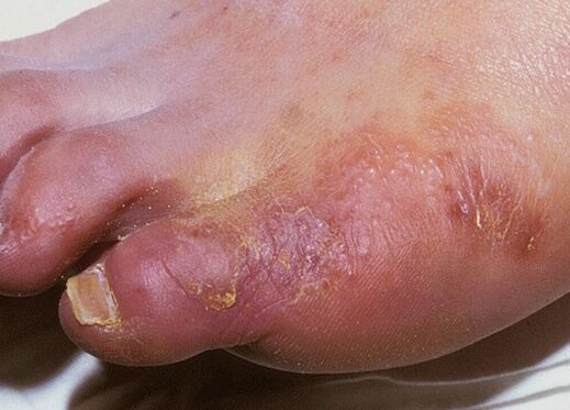 Un exemple d'infection fongique du pied causée par Trichophyton interdigitale