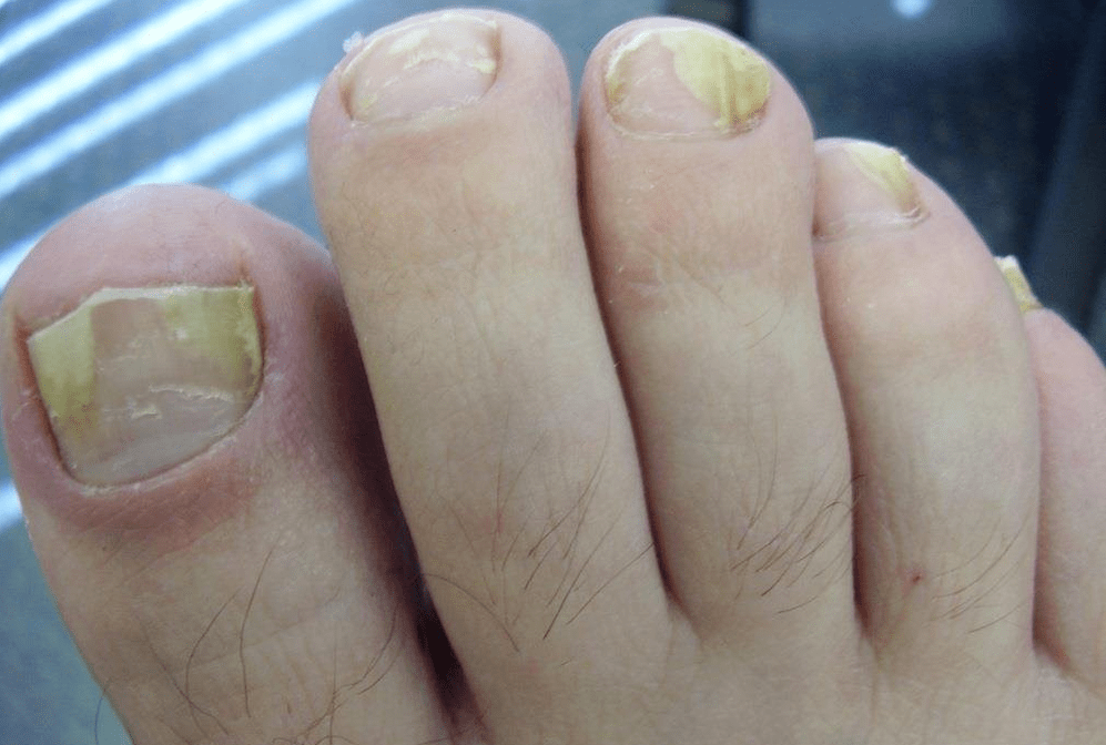 ongles jaunes dus à une infection fongique