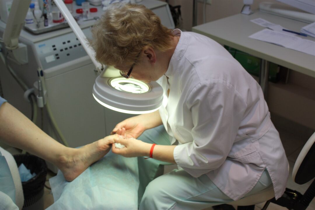 Le développement impressionnant de la mycose des ongles des pieds nécessite l'aide d'un chirurgien