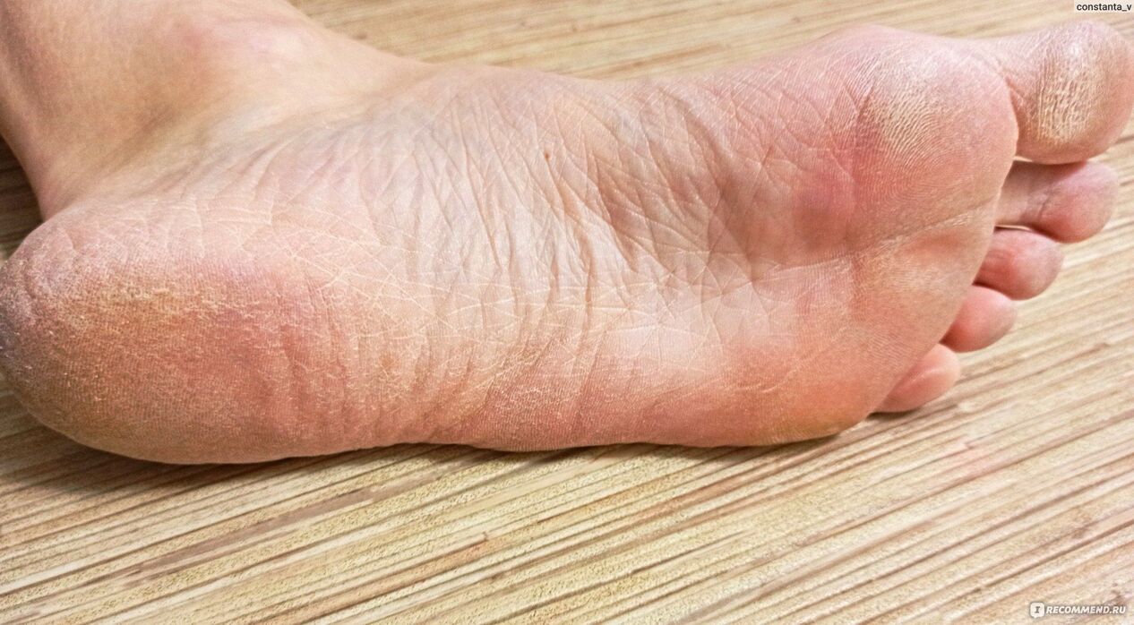 champignon sur le pied humain