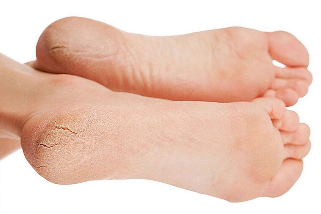 infection fongique des pieds